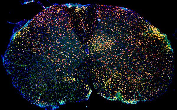 Immunfluoreszenz von entzündlich verändertem Rückenmark mit roten Mikrogliazellen und grünen aus dem Blut eingewanderten Makrophagen. 

Bildquelle: Universitätsklinikum Freiburg 